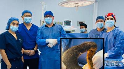 Vista de la masa de pelo extraída del estómago de una joven de 24 años de edad.