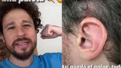 La foto de Luisito Comunica de cómo su agresor le dejó la oreja.