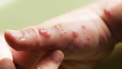 Caso de viruela del mono en Honduras