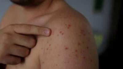 Autoridades sanitarias mantienen vigilancia epidemiológica intensificada ante la alerta regional, tras la confirmación de nuevos casos importados en el país.
