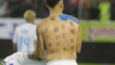 Luis Palma es el hombre del momento luego de que marcó dos goles que le dieron la victoria a la selección de Honduras ante México en el estadio Morazán. Conoce la curiosa razón de sus moretones en la espalda.
