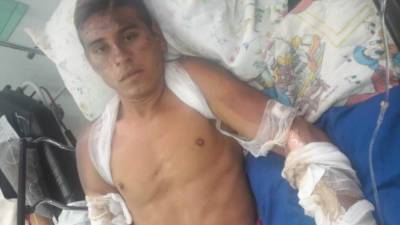 Con quemaduras graves está Ríos en una camilla del hospital Mario Rivas.