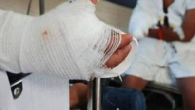 Uno de los menores ingresados la noche del miércoles 27 de diciembre fue afectado por un mortero que le causó daños en su mano derecha.