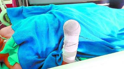 El agente de la Policía ayer se recuperaba en el IHSS después de que le amputaran la mano.