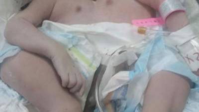 Las bebés se encontraban unidas en la parte de su abdomen, por lo que su diagnóstico era reservado.