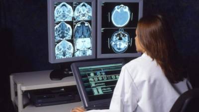 Las imágenes del cerebro puede establecer si padecera de un accidente cerebrovascular.