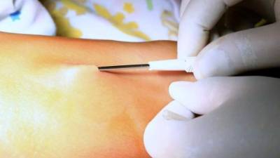 El anticonceptivo es insertado debajo de la piel del antebrazo de la mujer.