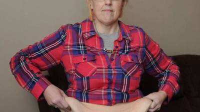 Una mujer vive desesperada por deshacerse de 12 kilos (26 libras) de exceso de piel que cuelgan de su abdomen.