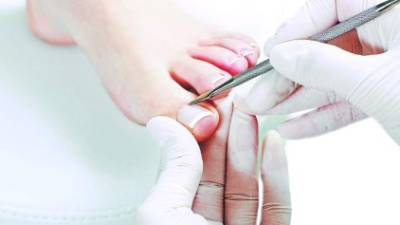 Es importante seguir el tratamiento con el médico para erradicar el hongo en las uñas del pie.