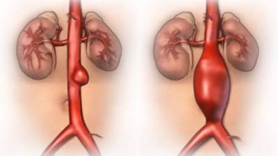 Los aneurismas abdominales 'son un asesino silencioso'.