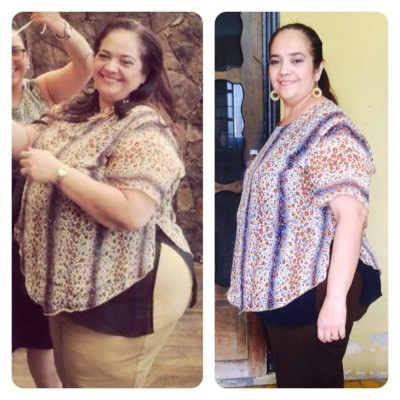 En dos meses se pierden casi 60 libras con cirugía bariátrica del IHSS