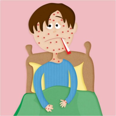 Me acaba de dar varicela y estoy lleno de ronchas. Mis vecinos se ríen de mí cuando me miran.