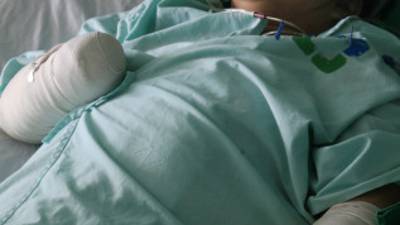 En la foto aparece Gloria Estela Pérez en su condición actual luego de perder ambas manos.