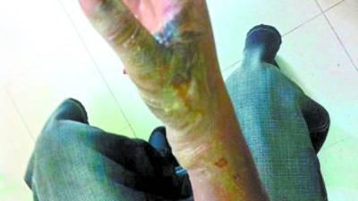 La manipulación de cohetes puede ocasionar severas quemaduras.