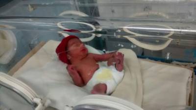 Los bebés son detectados al nacer. Si viene en una postura no convencional siempre se le hacen pruebas.