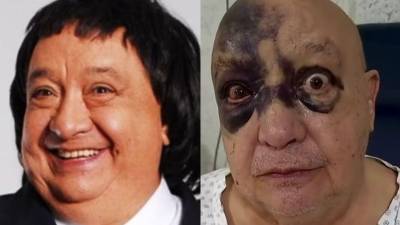 La imagen de Luis de Alba con el rostro cubierto de hematomas encendió las alarmas entre sus seguidores durante las últimas horas. Sin embargo, el reconocido actor y comediante mexicano decidió aparecer públicamente para explicar lo sucedido y tranquilizar a quienes se preocuparon por su estado de salud.