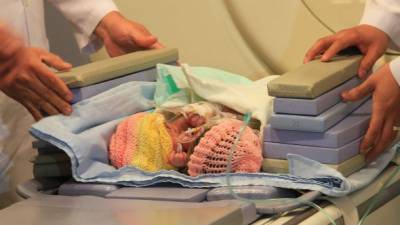 Las siamesas nacieron el viernes en el hospital Mario Catarino Rivas.