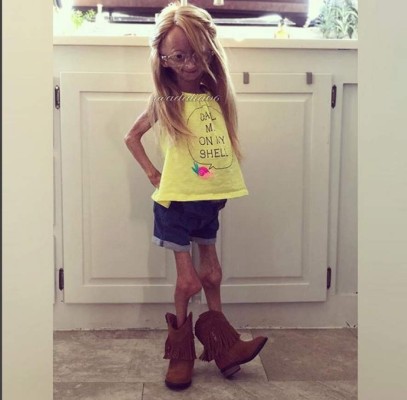 Adalia, la pequeña youtuber que envejece aceleradamente debido a su enfermedad