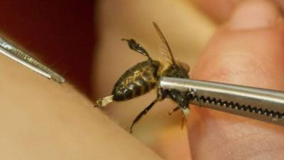 Actualmente se trata las picaduras de abeja con antiinflamatorios y antialérgicos.