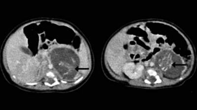 El hecho ocurrió en el 2010 pero fue revelado esta semana. La bebé de solo tres semanas de nacida tenía dos fetos unidos por cordones umbilicales.