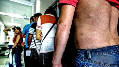 Cada vez es mayor el número de pacientes atendidos por zika en el hospital Mario Rivas.