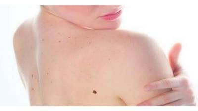 La persona que tiene lunares debe examinarlos anualmente.