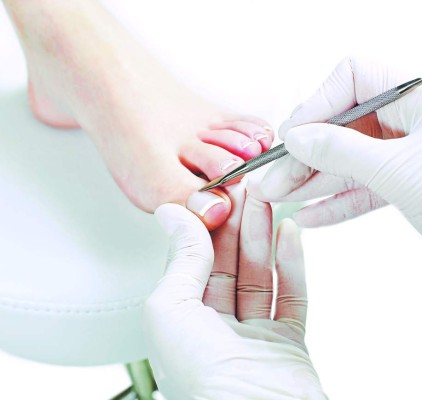 La onicomicosis, una infección que va transformando la uña