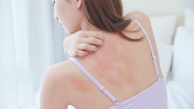 La dermatitis es una afección en la piel que puede ocasionar grandes molestias en la calidad de vida.