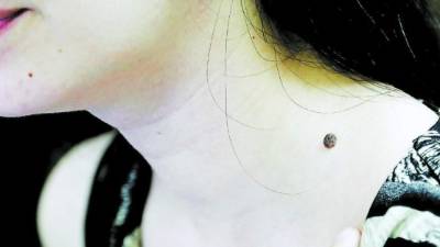 Este tipo de lunar, melanoma, debe ser removido para evitar el cáncer de piel.