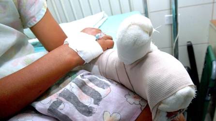 Fotografía de referecencia que muestra el brazo vendado de un niño por quemaduras.