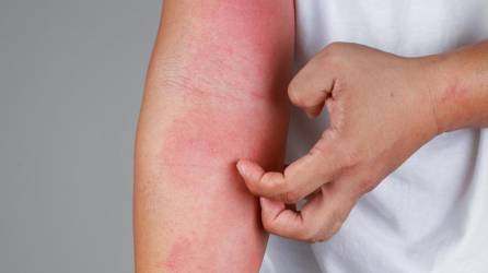 Alergias comunes de la piel en el invierno