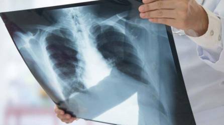 La pandemia de covid 19 contribuyó a un aumento de las muertes por tuberculosis, según estudio.