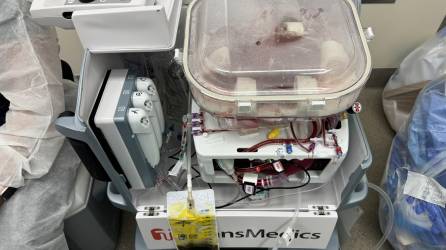 Una máquina de perfusión bombea sangre o un líquido oxigenado a los vasos sanguíneos de un órgano donado.