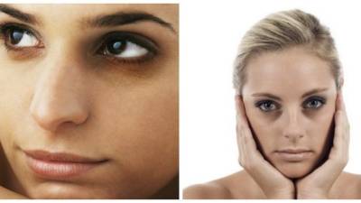 Las ojeras son esas marcas negras o también moradas que nos aparecen debajo de los ojos por falta de sueno y también por razones de estrés.