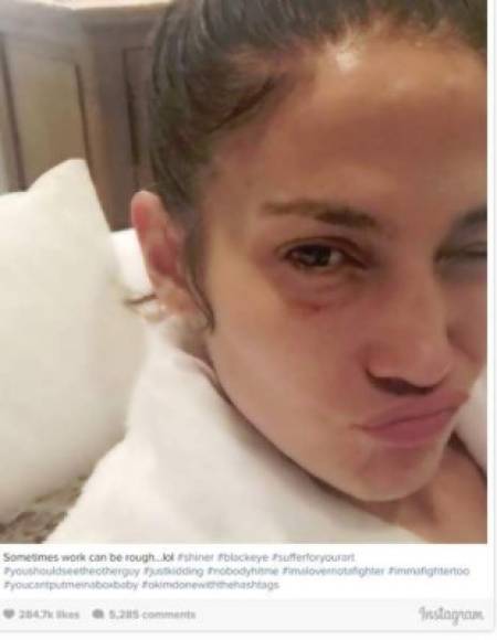 La cantante y actriz Jennifer López sorprendió a sus fans luego de compartir una foto en su cuenta de Instagram en la que aparece con el ojo morado. Pero no se alarmen, solo se trata de un accidente de trabajo. De hecho, algunos medios rumoran que fue un golpe que se dio durante las grabaciones de la serie Shades of Blue.