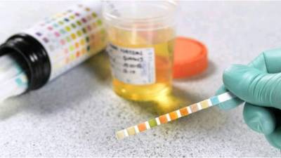 El análisis de orina puede detectar si está precente el cáncer de páncreas.