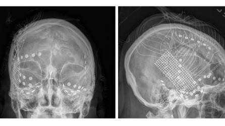 Electrodos registraron señales del cerebro de pacientes con epilepsia mientras escuchaban “Another Brick in the Wall”.