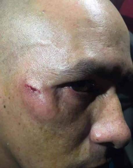 La piedra impactó en el árbitro Matute. En su rostro es evidente las secuelas de la agresión.