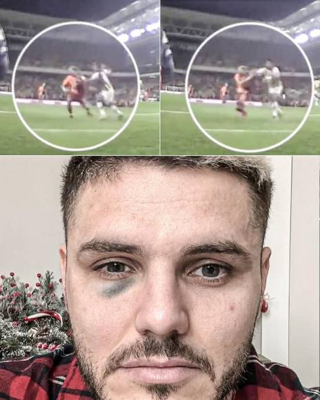 Mauro Icardi publicó una imagen a sus redes sociales de como le quedó su rostro tras una agresión que sufrió en el partido de su equipo Galatasaray contra el Fenerbahce.