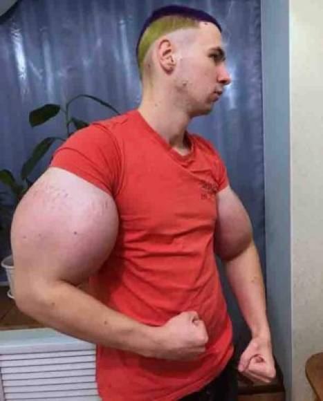 El chico ruso de 22 años de edad se inyectó una mezcla casera de aceites en los brazos para aumentar el tamaño de estos.
