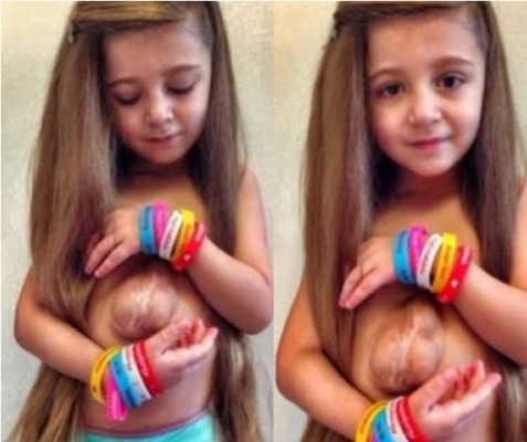Niña sobrevive seis años con el corazón fuera del pecho