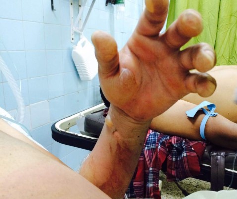 Cuatro heridos en Tegucigalpa al explotar tanque de gas de un taxi