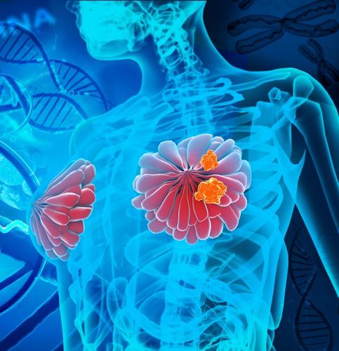 La OMS lanza portal con IA para alertar sobre el vínculo entre alcohol y cáncer de mama