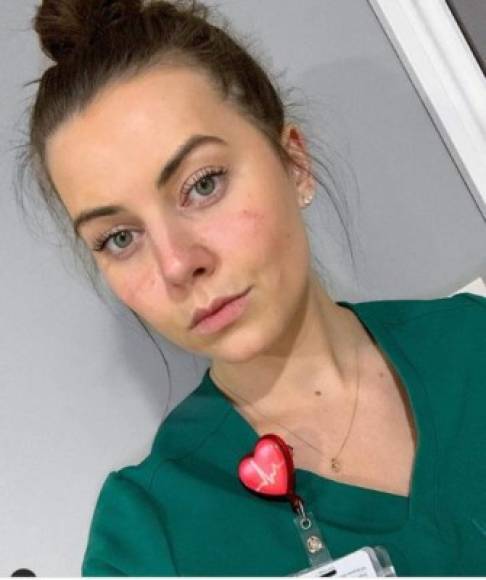 La enfermera estadounidense identificada únicamente como Bárbara informó que usar las máscarillas N95 entre 5-8 minutos para administrar medicamentos a un paciente infectado por Covid 19 deja severas marcas en los rostros del personal médico.⁣