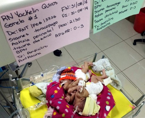 No se hizo nada para salvar la vida de las siamesas sampedranas