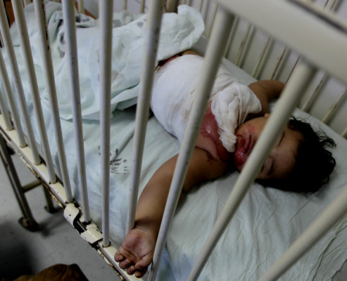 Hospitales Mario Rivas y Escuela atienden 14 quemados de la Navidad