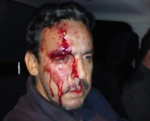 Los heridos, el periodista gráfico nicaragüense Magdiel Midence y el otro afectado Antonio Flores.
