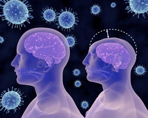 Unos escáneres muestran una variedad de defectos vinculados con el Zika en el cerebro de los bebés