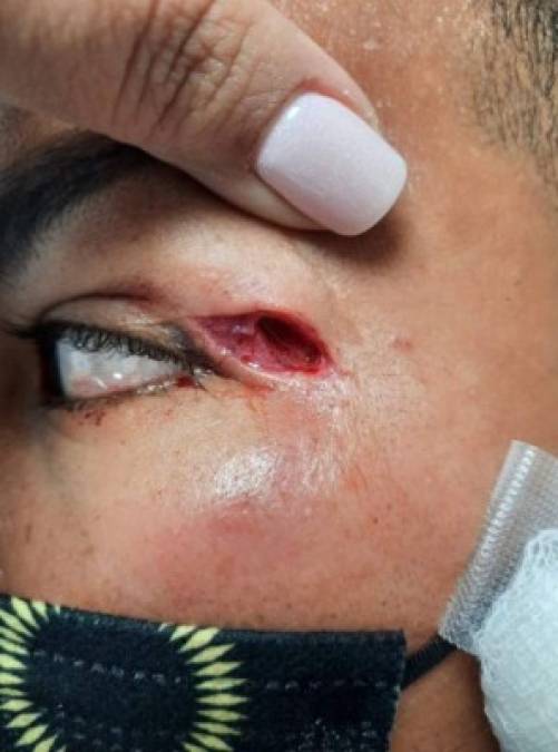 Imagen no apta para sensibles. Así fue la terrible herida que sufrió Mario Martínez tras el codazo de Jonathan Paz.
