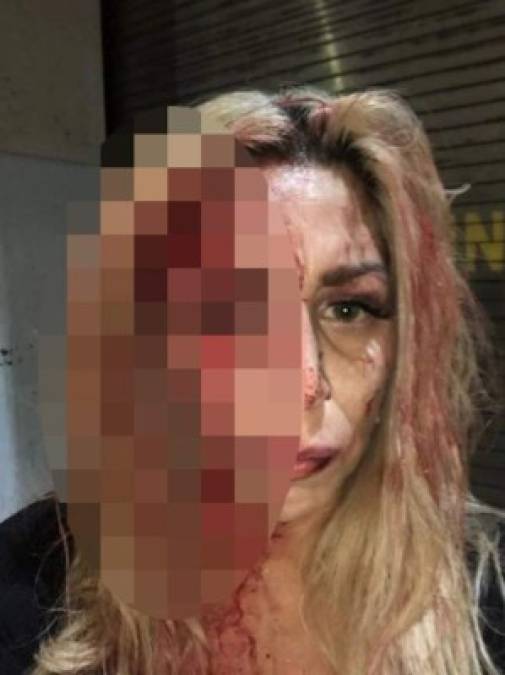 'Fue una estampida cuando nos íbamos (…), no puedo decirte cuántas personas' contó Agostini mostrando fotos de sangre y heridas en su rostro.